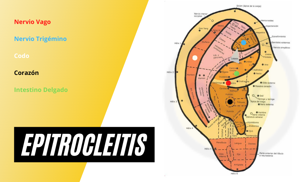 Epitrocleitis auriculoterapia.png